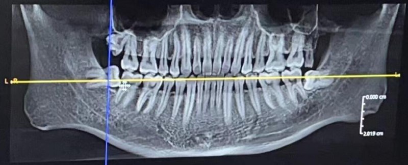 V2EX-最热主题周末终于去拔了智齿#v2exbrader: 医生技术真好，先拔左边两颗，打完麻药开始拔，几分钟就给我搞定了