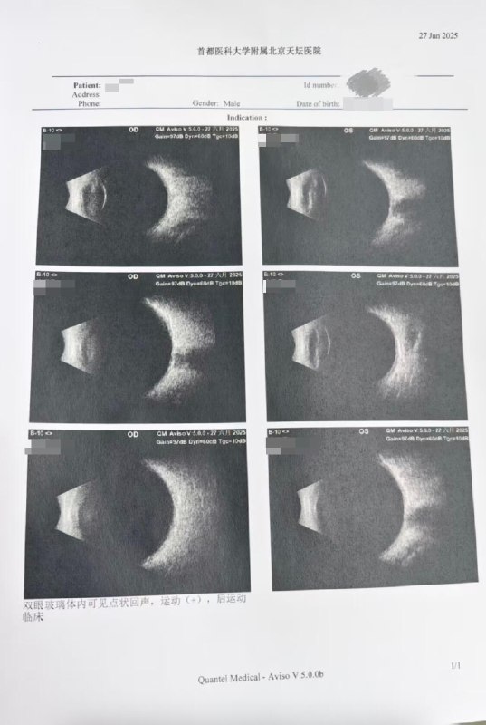 V2EX-最热主题突然就飞蚊症了，有三周了，医生说等大阴影变大了可以去做激光消除，有没有“病友”？#v2exlengmou:已经有三周了，我记得那个周一，走在路上总感觉左眼有个小虫子，飘来飘去， 一开始以为眼镜上有虫子，摘了之后发现还有，才知道是飞蚊症